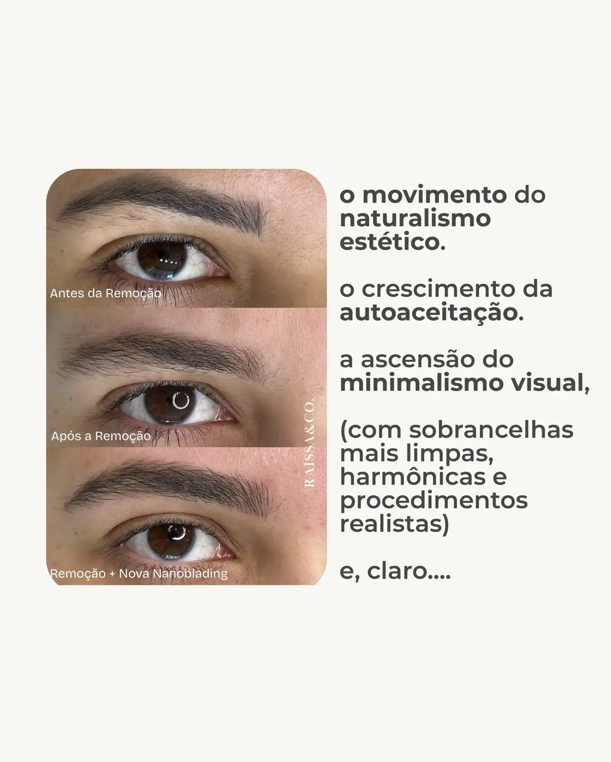 Evolução de sobrancelha com micropigmentação antiga, remoção e novo resultado natural